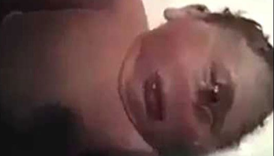 هولوپروزنسفالی-دجال یک چشم