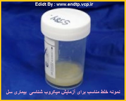 تعریف یک نمونه خلط مناسب برای تشخیص بیماری سل