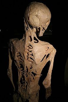http://s6.picofile.com/file/8192977250/230px_Fibrodysplasia_ossificans_progressiva.jpg