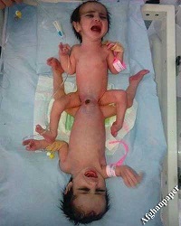 تولد دو کودک به هم چسبیده در بدخشان 
