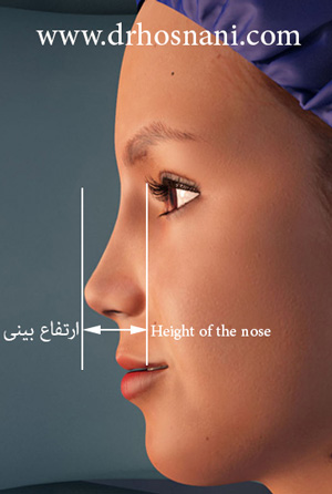 کاهش ارتفاع بینی با جراحی