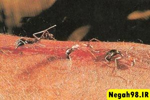 مورچه های شگفت آوری که جراحی میکنند(از دست ندین)