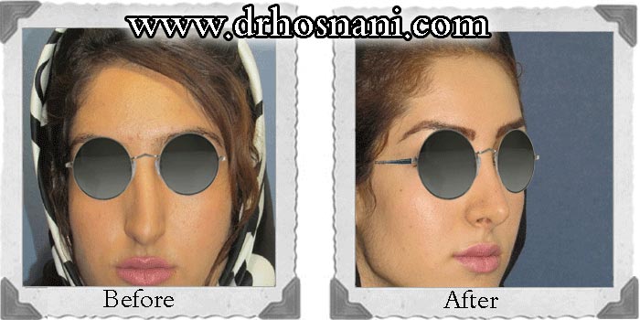 جراحی بینی - اصلاح انحراف بینی