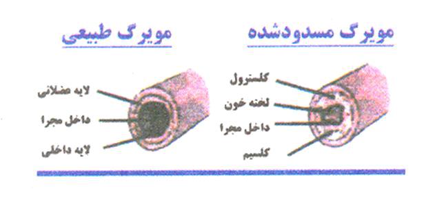 آنژين صدري