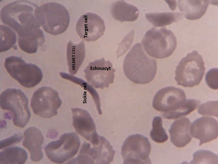 اطلس مرفولوژی گویچه های قرمز خون RBC Morphology