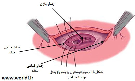 Vesicovaginal Fistula