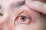 آب سیاه چشم چگونه با طب سنتی درمان می شود؟
