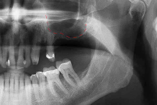 عمل جراحی لیفت سینوس پیش از کاشت ایمپلنت دندان 