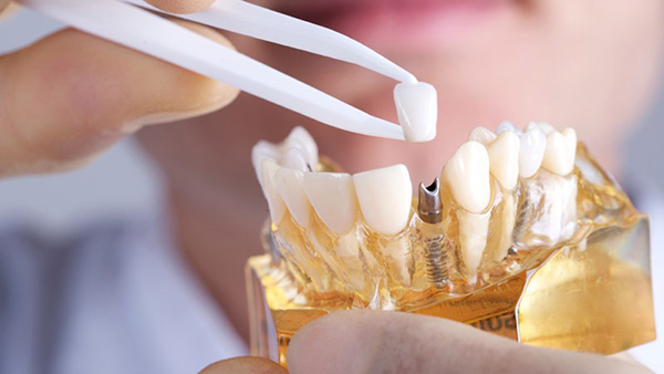 از چه سنی میتوان ایمپلنت دندان کاشت؟