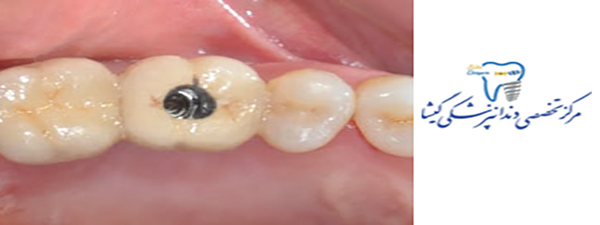اباتمنت دندان چیست؟