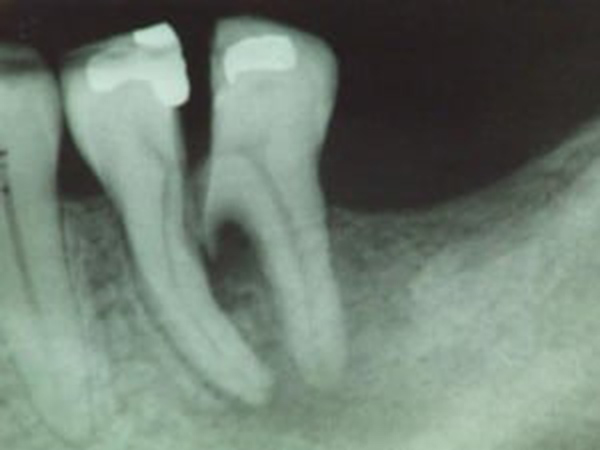  از کجا بدانیم باید پر شدگی دندان را عوض کنیم؟