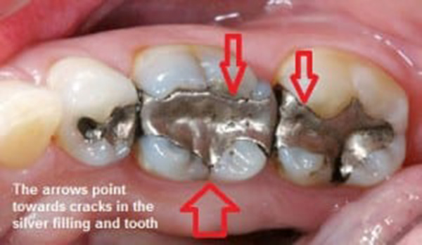 از کجا بدانیم باید پر شدگی دندان را عوض کنیم؟