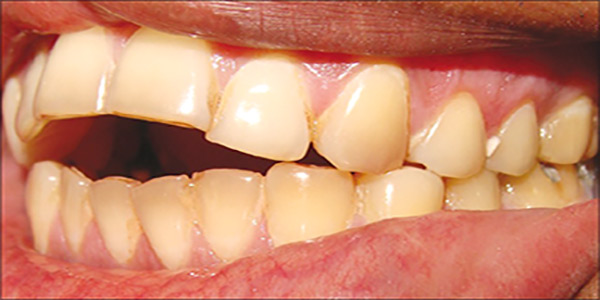 درمانهای اپن بایت یا به هم نرسیدن دندانهای جلویی در بزرگسالان