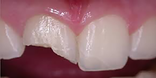 کاربردهای روکش دندان در دندانپزشکی