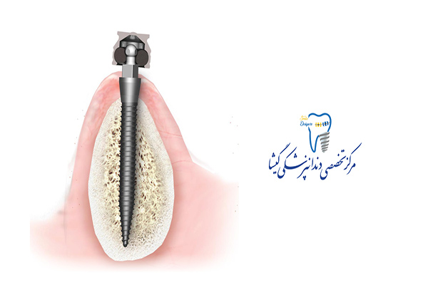 معایب و مزایای مینی ایمپلنت در مقابل ایمپلنت دندان معمولی