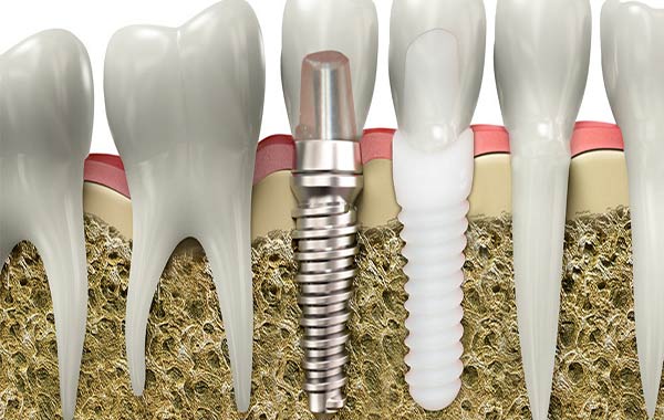 ایمپلنت دندان تیتانیومی بهتر است یا زیرکونیا؟