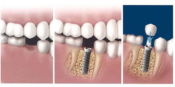 ایمپلنت دندان تیتانیومی بهتر است یا زیرکونیا؟