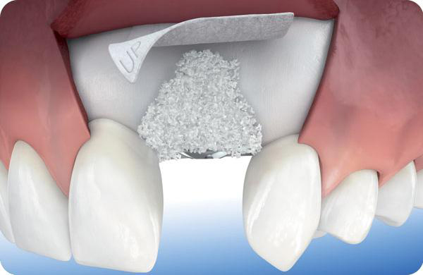 بزرگ کردن ستیغ فک پیش از کاشت ایمپلنت دندان