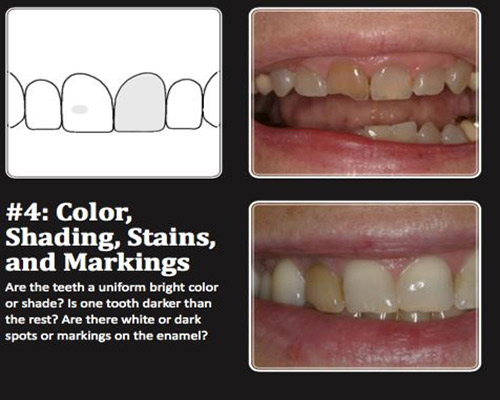 طراحی لبخند توسط دندانپزشک متخصص ترمیمی و زیبایی دندان