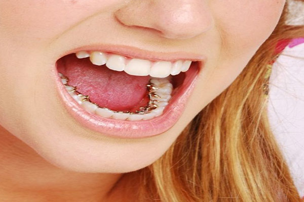 براکت پشت دندانی معایب و مزایای براکت پشت دندانی یا لینگوال