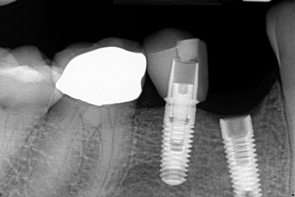 شل شدن پیچ ایمپلنت دندان
