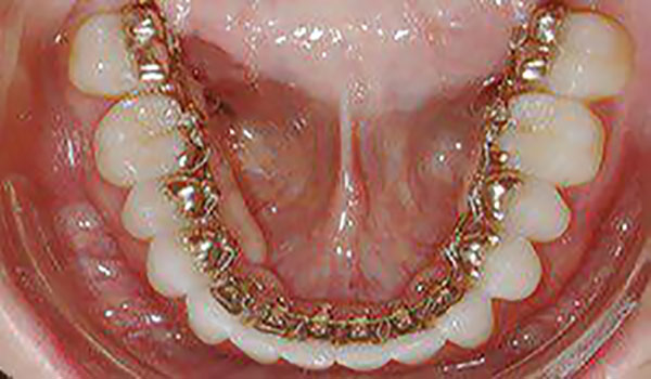 همه چیز در مورد ارتودنسی دندانها