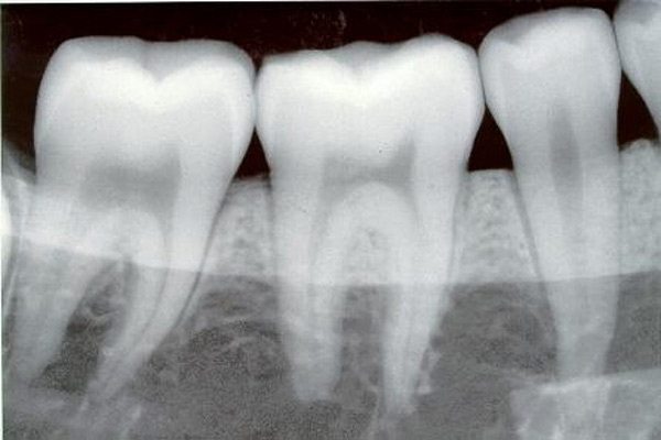 عکس پرتوی ایکس دندانپزشکی
