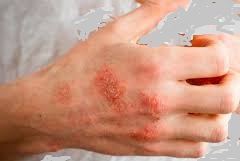 اگزما(Atopic dermatitis)چیست+درمان