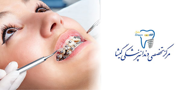 ارتودنسی ثابت توسط متخصص ارتودنسی خوب در غرب تهران
