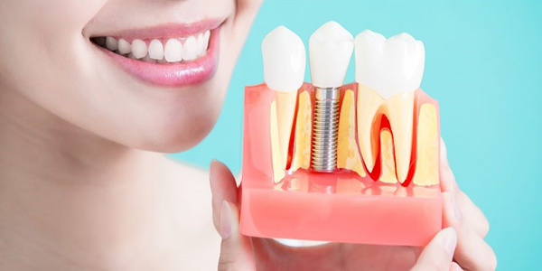 چرا باید ایمپلنت دندان بکاریم؟