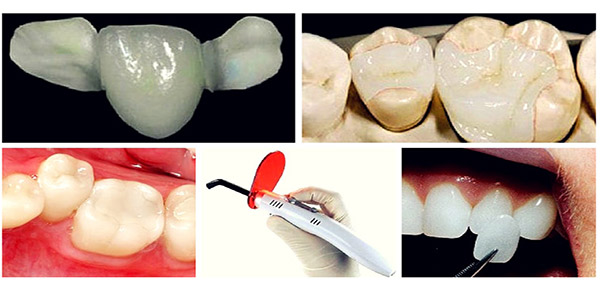 انواع کامپوزیت های در دسترس برای کارهای زیبایی دندان