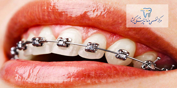 ارتودنسی دندانها حتی در سنين بالا توسط متخصص ارتودنسی
