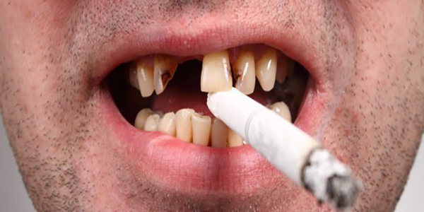 کاشت ایمپلنت دندان در افراد سیگاری