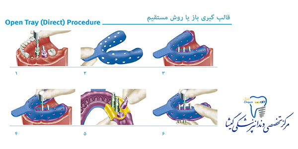 روشهای قالب گیری ایمپلنت توسط متخصص پروتزهای دندانی و ایمپلنت در تهران