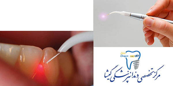  دندان پزشکی بدون درد توسط متخصص ایمپلنت در تهران