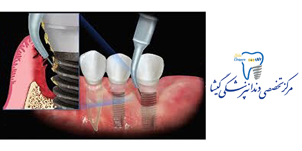 کاربرد لیزر در دندان پزشکی
