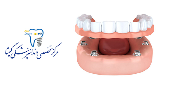 اوردنچر متکی بر ایمپلنت های دندانی توسط متخصص ایمپلنت در تهران