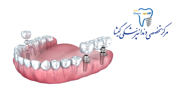 پروتز پارسیل ( تیکه ای) توسط متخصص پروتزهای دندانی وایمپلنت در تهران