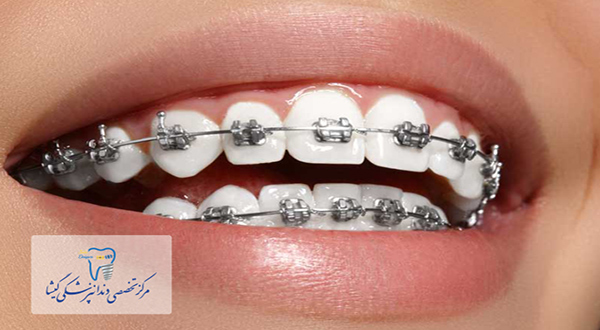 ارتباط متخصص ارتودنسی با متخصص لثه و دندانپزشكی ترميمی