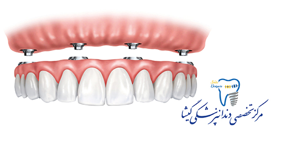 طرح درمان های موجود برای بی دندانی کامل