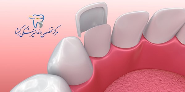 توضیحات متخصص زیبایی دندان در تهران