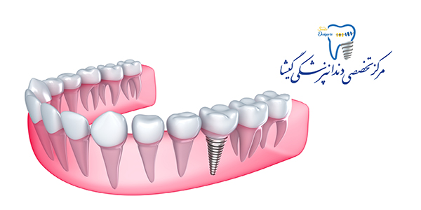 مراحل درمان ایمپلنت دندان توسط متخصص ایمپلنت در تهران