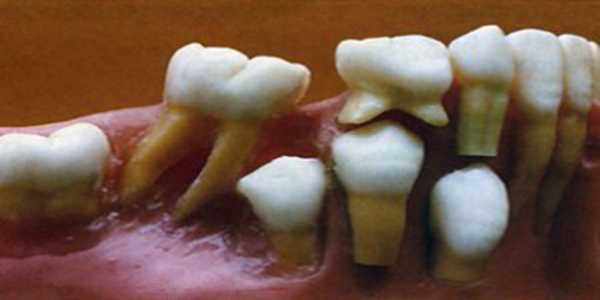 عوارض و مشکلات ارتودنسی از دست دادن دندان شیری
