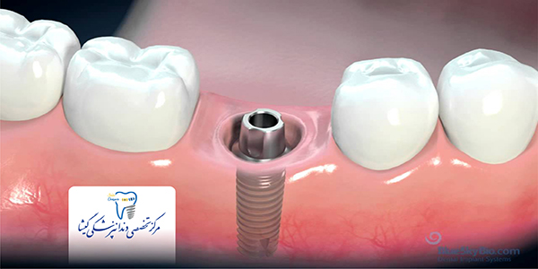 بهترین شرایط برای کاشت دندان ( ایمپلنت) توسط بهترین متخصص ایمپلنت در غرب تهران